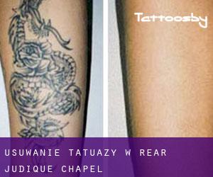 Usuwanie tatuaży w Rear Judique Chapel