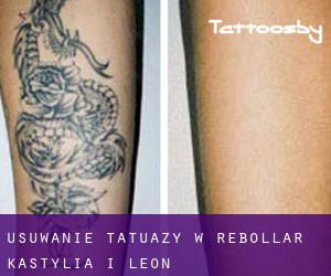 Usuwanie tatuaży w Rebollar (Kastylia i León)