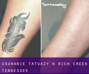 Usuwanie tatuaży w Rich Creek (Tennessee)