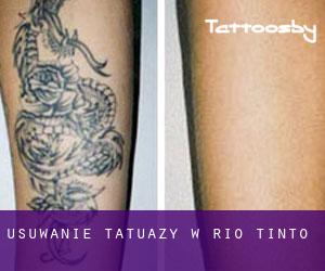 Usuwanie tatuaży w Rio Tinto