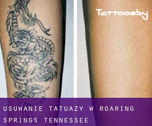 Usuwanie tatuaży w Roaring Springs (Tennessee)