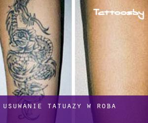 Usuwanie tatuaży w Roba