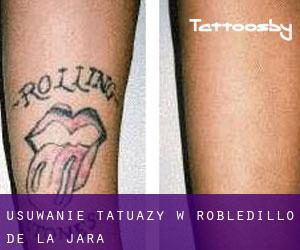 Usuwanie tatuaży w Robledillo de la Jara