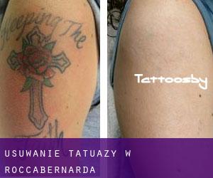 Usuwanie tatuaży w Roccabernarda
