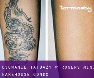 Usuwanie tatuaży w Rogers Mini Warehouse Condo