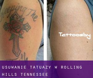 Usuwanie tatuaży w Rolling Hills (Tennessee)