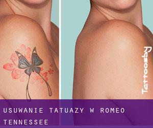 Usuwanie tatuaży w Romeo (Tennessee)