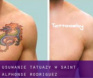 Usuwanie tatuaży w Saint-Alphonse-Rodriguez