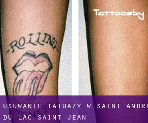Usuwanie tatuaży w Saint-André-du-Lac-Saint-Jean