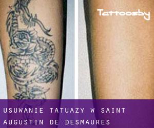 Usuwanie tatuaży w Saint-Augustin-de-Desmaures