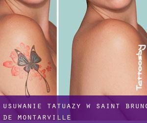 Usuwanie tatuaży w Saint-Bruno-de-Montarville