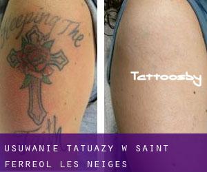 Usuwanie tatuaży w Saint-Ferreol-les-Neiges