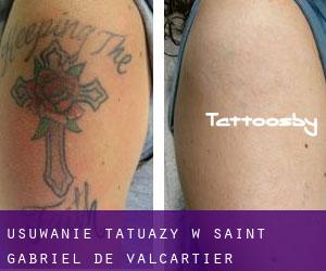 Usuwanie tatuaży w Saint-Gabriel-de-Valcartier