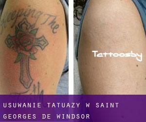 Usuwanie tatuaży w Saint-Georges-de-Windsor