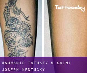 Usuwanie tatuaży w Saint Joseph (Kentucky)