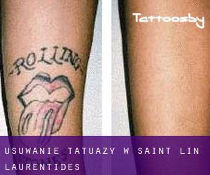 Usuwanie tatuaży w Saint-Lin-Laurentides