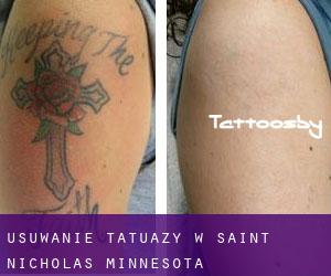 Usuwanie tatuaży w Saint Nicholas (Minnesota)
