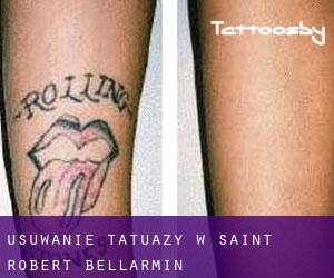 Usuwanie tatuaży w Saint-Robert-Bellarmin