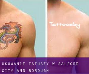 Usuwanie tatuaży w Salford (City and Borough)