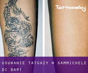 Usuwanie tatuaży w Sammichele di Bari