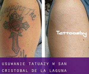Usuwanie tatuaży w San Cristóbal de La Laguna
