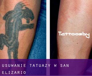 Usuwanie tatuaży w San Elizario