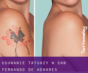 Usuwanie tatuaży w San Fernando de Henares