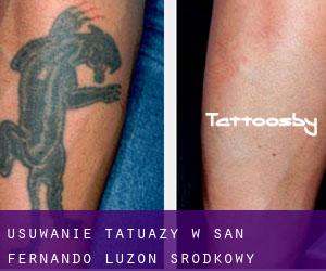 Usuwanie tatuaży w San Fernando (Luzon Środkowy)