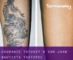 Usuwanie tatuaży w San Juan Bautista Tuxtepec