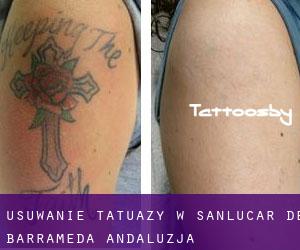 Usuwanie tatuaży w Sanlúcar de Barrameda (Andaluzja)