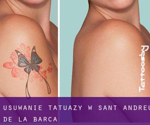 Usuwanie tatuaży w Sant Andreu de la Barca