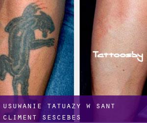 Usuwanie tatuaży w Sant Climent Sescebes