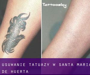 Usuwanie tatuaży w Santa María de Huerta