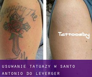 Usuwanie tatuaży w Santo Antônio do Leverger