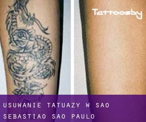 Usuwanie tatuaży w São Sebastião (São Paulo)