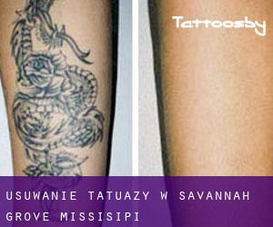 Usuwanie tatuaży w Savannah Grove (Missisipi)