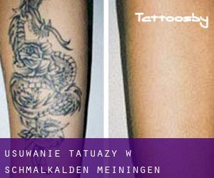 Usuwanie tatuaży w Schmalkalden-Meiningen Landkreis