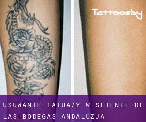Usuwanie tatuaży w Setenil de las Bodegas (Andaluzja)