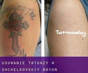 Usuwanie tatuaży w Shchëlkovskiy Rayon