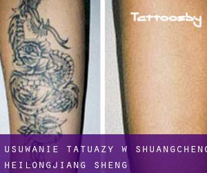 Usuwanie tatuaży w Shuangcheng (Heilongjiang Sheng)