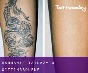 Usuwanie tatuaży w Sittingbourne