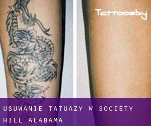 Usuwanie tatuaży w Society Hill (Alabama)
