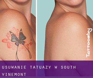 Usuwanie tatuaży w South Vinemont