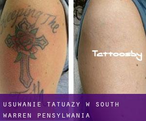 Usuwanie tatuaży w South Warren (Pensylwania)