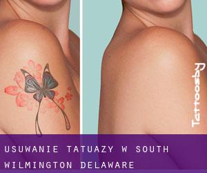 Usuwanie tatuaży w South Wilmington (Delaware)