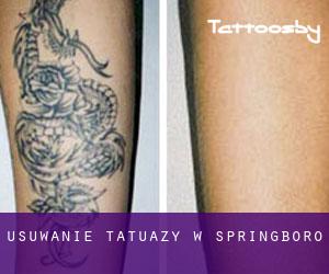 Usuwanie tatuaży w Springboro