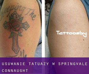 Usuwanie tatuaży w Springvale (Connaught)