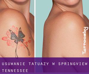 Usuwanie tatuaży w Springview (Tennessee)