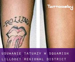 Usuwanie tatuaży w Squamish-Lillooet Regional District