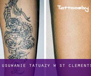 Usuwanie tatuaży w St. Clements